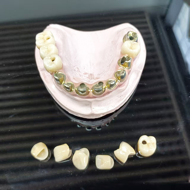 Metal-keramický můstek s plnou klenbou (PFM Full Arch Prothesis)